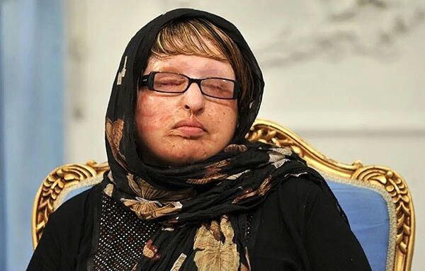 آمنه بهرامی؛ همچنان در تلاش برای دریافت دیه چشمانش