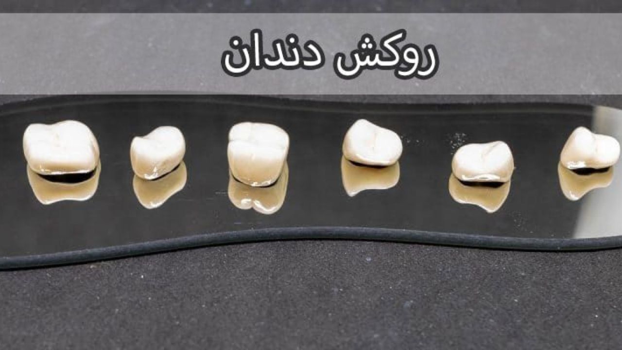 انواع روکش دندان