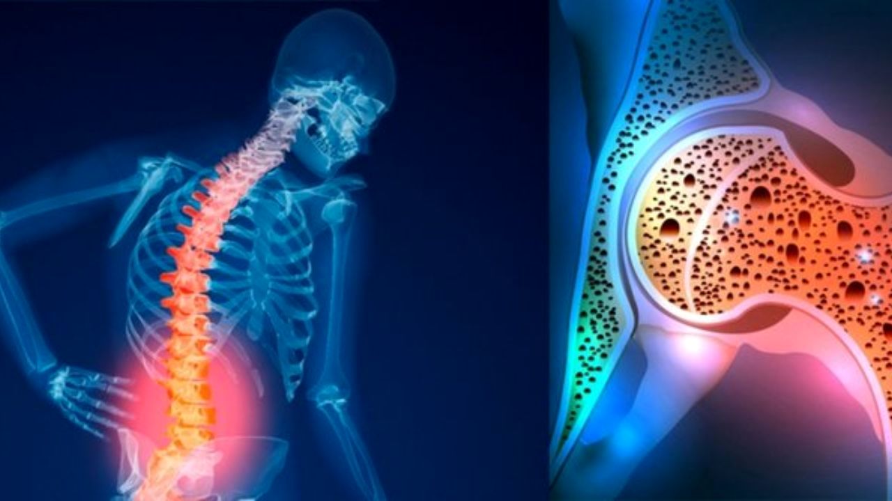 پوکی استخوان بیش از 40 درصد ایرانیان/گسترش بیماری‌های غیرواگیر به دنبال سبک زندگی نامناسب