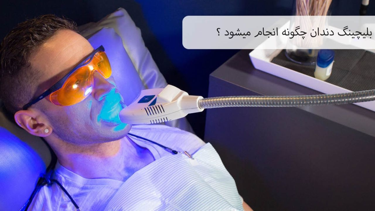 بلیچینگ دندان چگونه انجام می‌شود؟