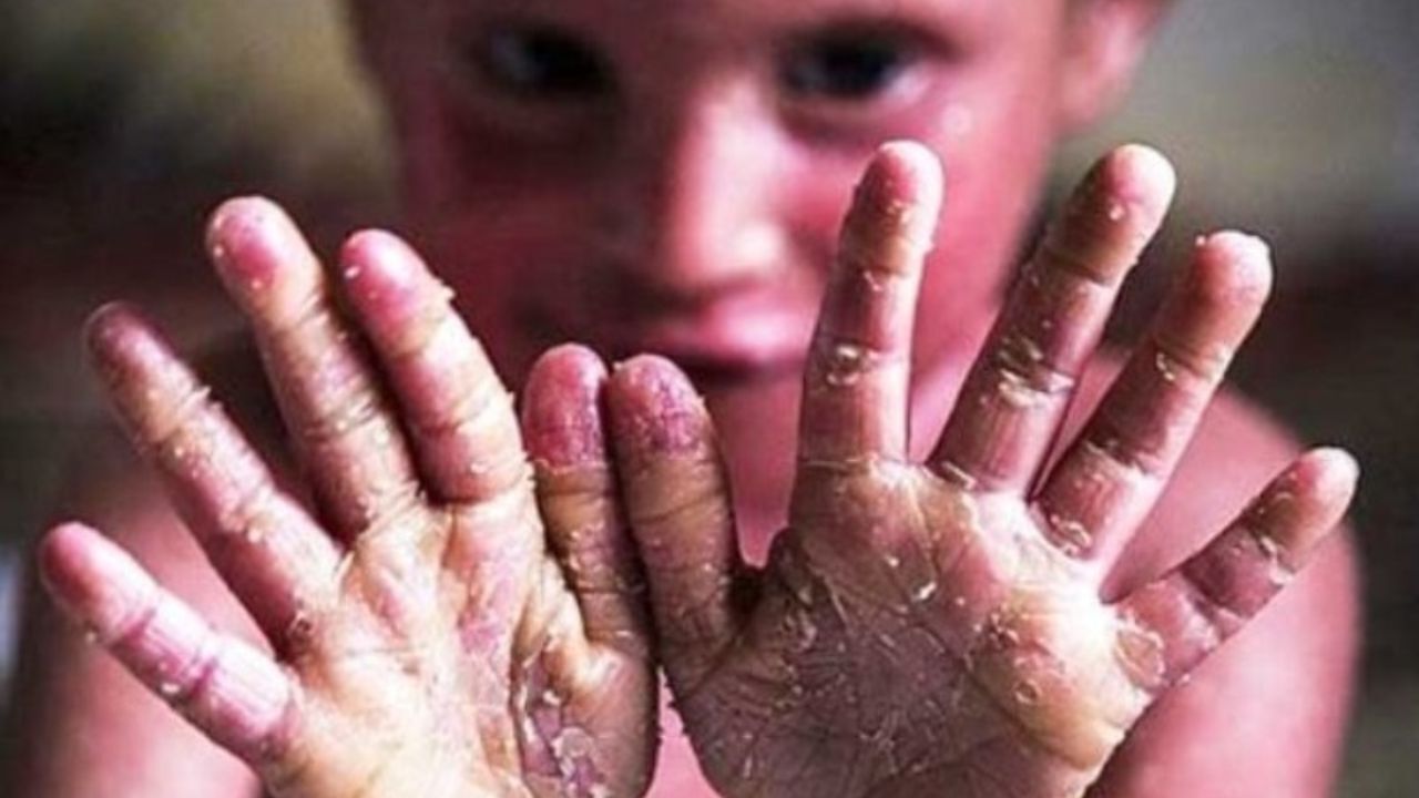 بیش از 70 هزار قطعه پانسمان بیماران " ای بی " تحویل داده شد