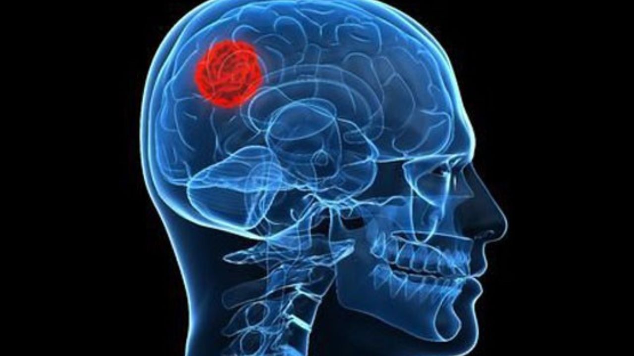 حرکت محققان به سمت تشخیص تومورهای کوچک