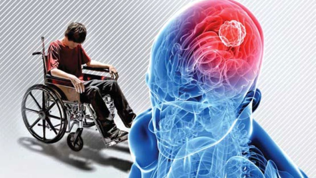 ابتلای 75 هزار ایرانی به بیماری ام اس