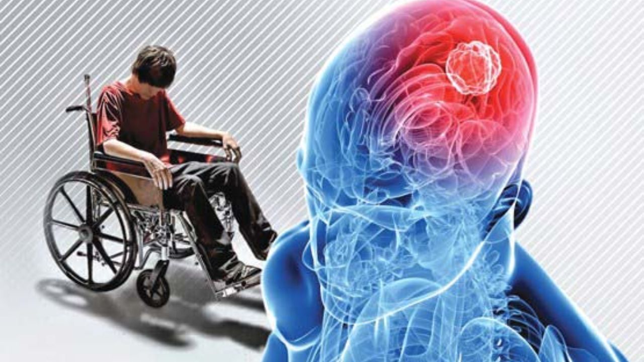 ابتلای 75 هزار ایرانی به بیماری ام اس