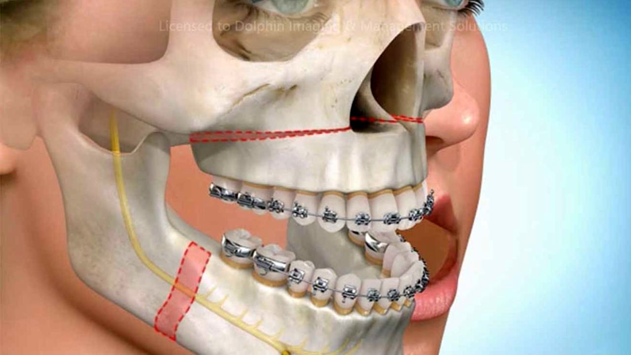 اختراع وسیله‌ای برای ناهنجاری فک در کودکان توسط متخصصان ایرانی