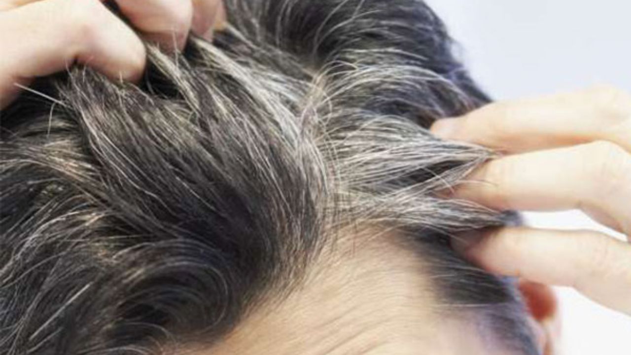 چگونه شپشِ سر را از شوره تشخیص دهیم؟