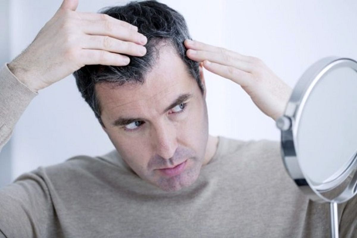 علت ریزش مو در بهبودیافتگان کرونا چیست؟