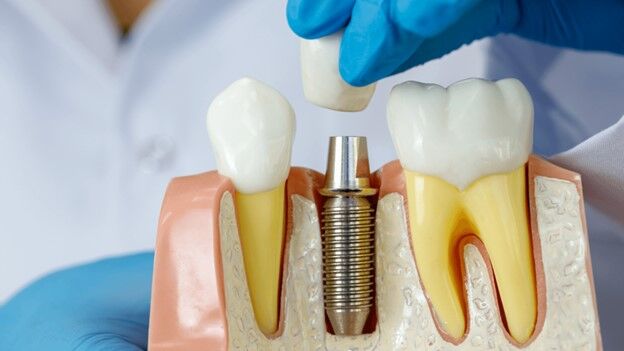 چگونه از ایمپلنت دندان خود مراقبت کنیم؟